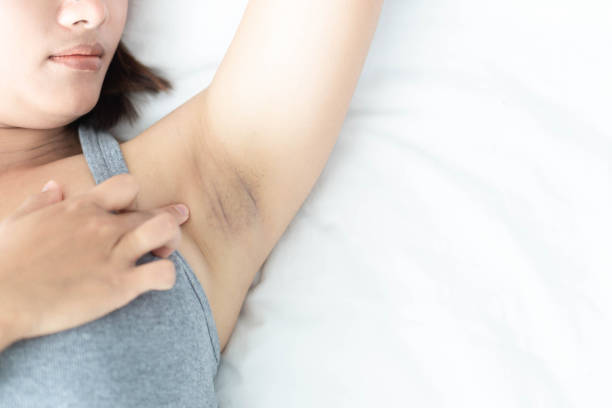 Woman lying down and scratching her armpit, showing signs of irritation or discoloration under the arm.